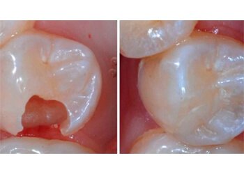 Ultra Sorriso Clínica Odontológica - Serviços Clínicos - Restauração Dental/Obturação