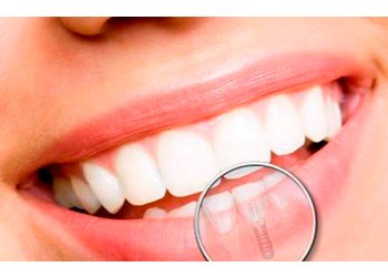 Ultra Sorriso Clínica Odontológica - Serviços com Implantes - Implante Dentário
